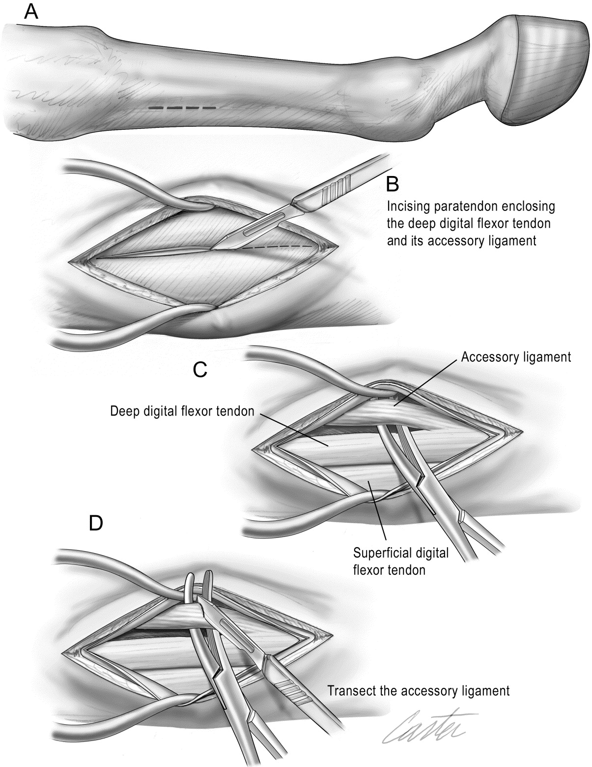 Inferior Check Ligament Desmotomy